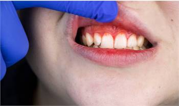 Periodontal Disease: Definition & Causes